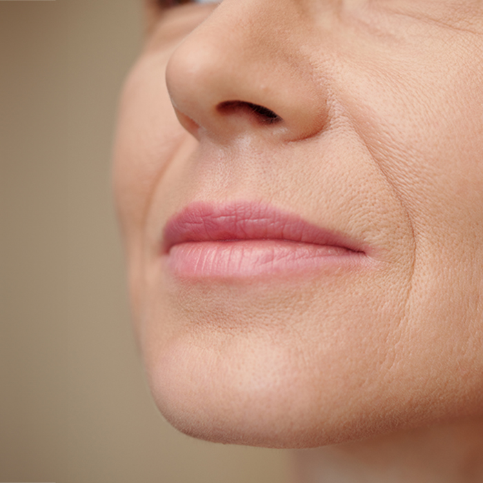 Улучшение морщин в области уголков рта и подбородка. Thumbnail